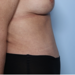 Tummy Tuck Before & After Patient #34291